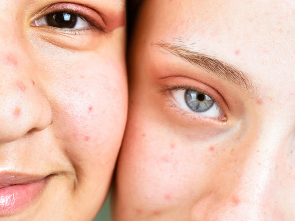 Nova rotina de skincare deu acne? Descubra se é purging ou breakout