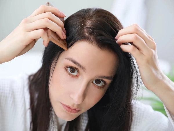 Psoríase no couro cabeludo: O que é? Como tratar?